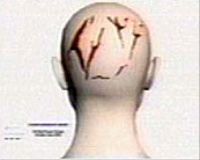 Peterson autopsy diagram